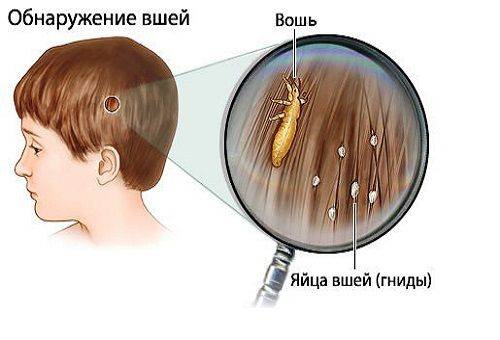 lice in hair