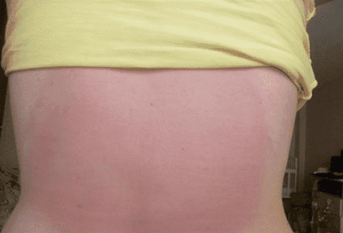 burn on skin from ointment finalgon