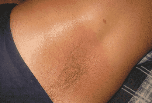 burn on skin from ointment finalgon