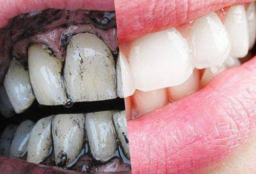 teeth before and after whitening