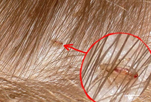 Louse in hair
