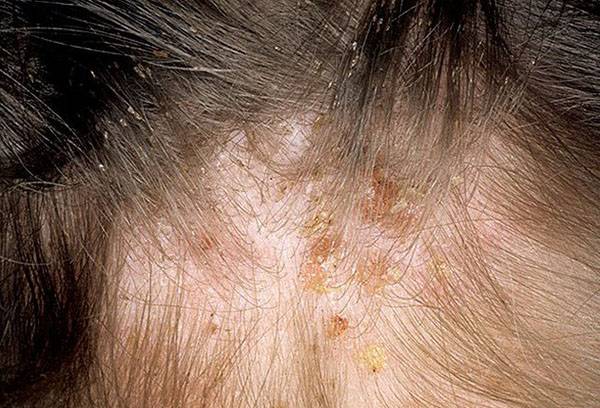 Pediculosis