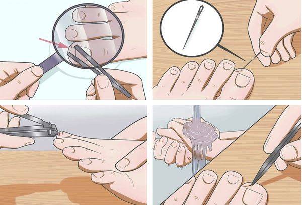Splinter Removal