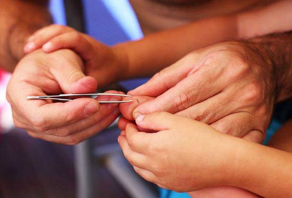 Extraction of tweezers by tweezers