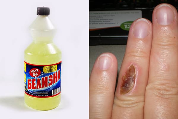 Burn on a finger from White